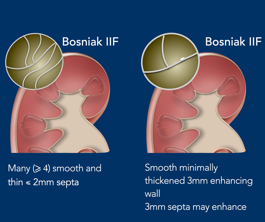 Bosniak IIF and Bosniak III renal cyst criteria