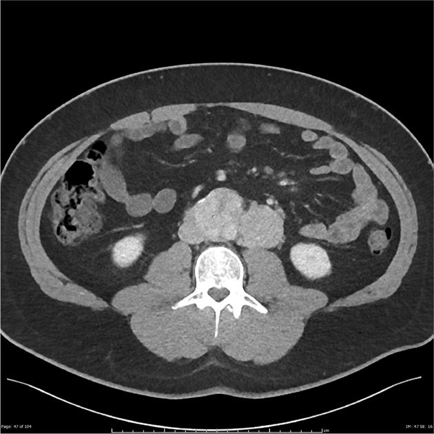 Organ of Zuckerkandl