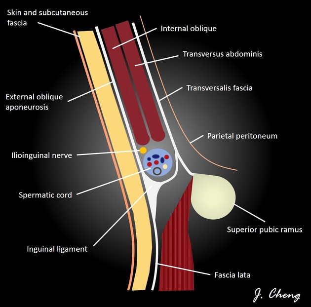 A sagittal schematic of the male inguinal canal demonstrating its boundaries and relations.
Case Discussion
Due to its oblique course through multiple layers of fascia, the walls of the inguinal canal can be difficult to conceptualise. This diagram attempts to simplify the boundaries and structures within the canal. This diagram pertains to males; however, in females the spermatic cord will be replaced by the round ligament.