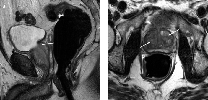Figure 6. a, b. Sagittal T2-weighted image (a) of a 63-year-old male with type 3 BPH shows retrourethral enlargement (arrow). Axial T2-weighted image (b) shows bilateral marked BPH nodules (arrows).