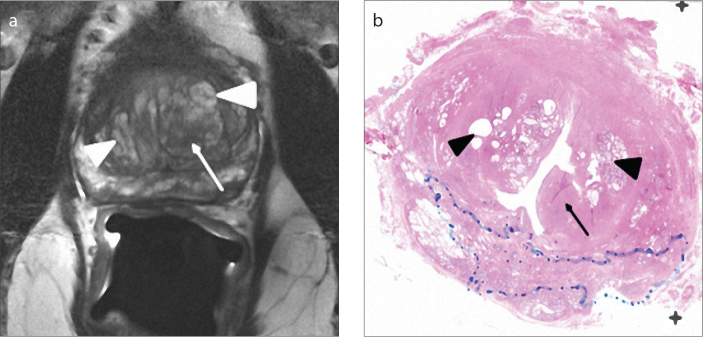 Figure 2. a, b. Axial T2-weighted image (a) of a 69-year-old male with type 3 BPH shows a hypointense area (arrow) in the left transition zone and bilateral predominantly hyperintense areas (arrowheads). On the pathology section (b), the hypointense area is compatible with a pure stromal BPH nodule (arrow), and bilateral predominantly hyperintense areas are compatible with mixed type BPH nodules consisting of mostly glandular components with cystic glands (arrowheads).
