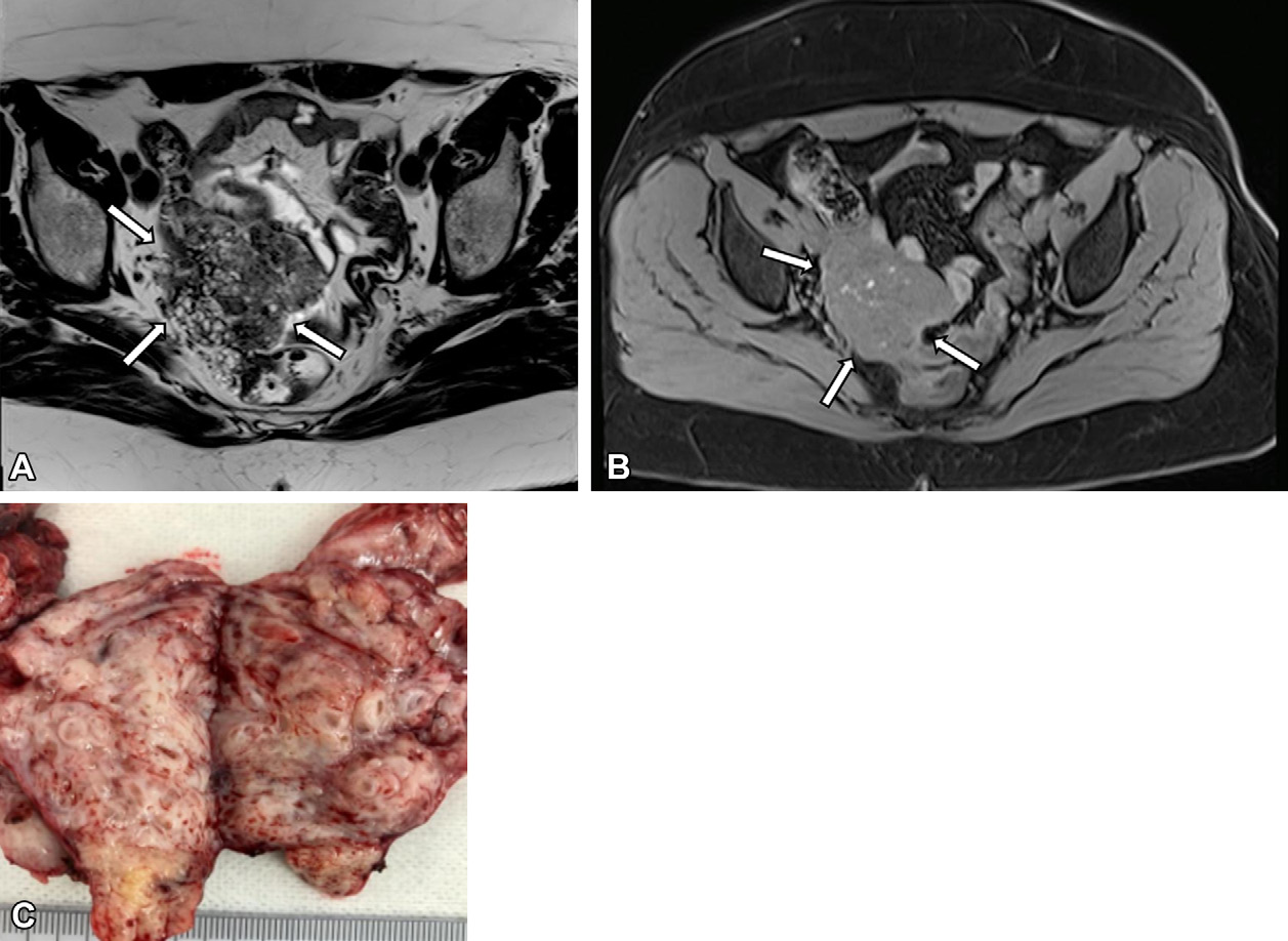 Figure 10. Presumed adnexal lesion in a 42-year-old woman with a postsurgical diagnosis of an extrauterine adenomyoma.
- (A) Axial T2-weighted MR image shows a lobulated mass (arrows) in the right pelvic paramedian region, containing cystic areas with high signal intensity interspersed with a hypointense fibrous stroma.
- (B) Axial T1-weighted MR image with fat suppression shows small hemorrhagic cystic foci in the lesion (arrows).
- (C) Photograph of the surgical specimen shows whorled, white, firm areas.