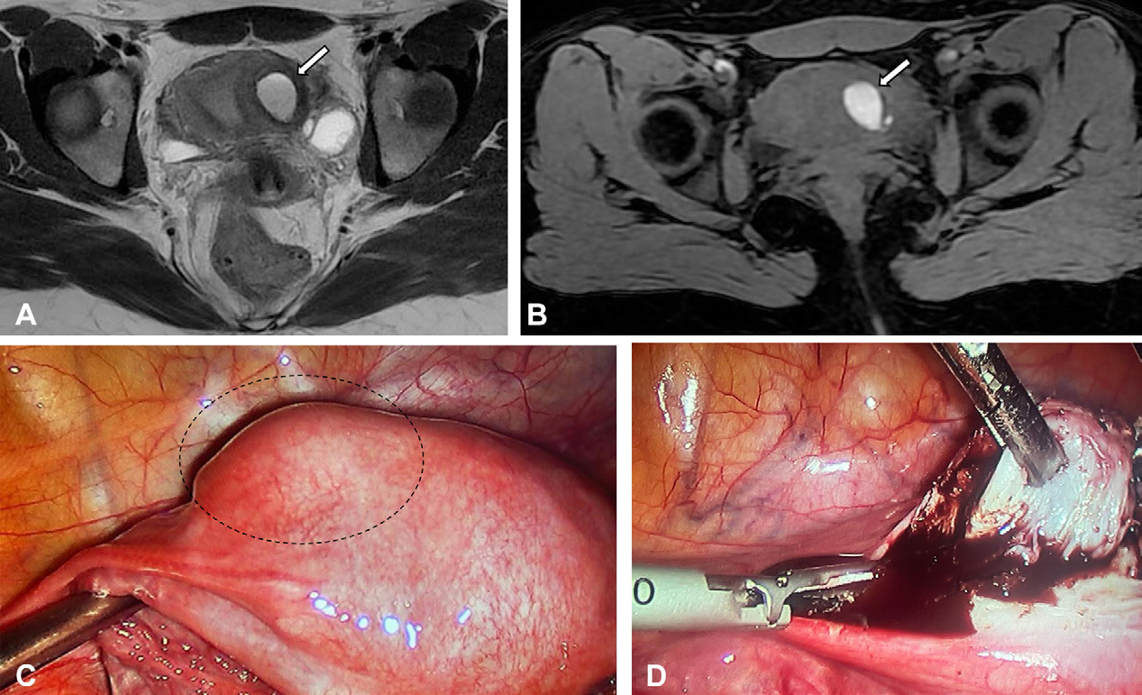 Figure 9. ACUM in a 14-year-old nulliparous adolescent girl with intense dysmenorrhea since menarche.
- (A) Axial T2-weighted MR image shows a cystic cavity lined with endometrium and surrounded by a hypointense halo in the left uterine body (arrow).
- (B) Axial T1-weighted MR image with fat saturation shows prominent high signal intensity in the central cavity, corresponding to hemorrhagic content (arrow).
- (C) Laparoscopic surgical view shows the mass on the left side of the uterus, bulging the organ (dashed circle).
- (D) Laparoscopic surgical view shows a section of the mass with chocolate-colored fluid spilling out.