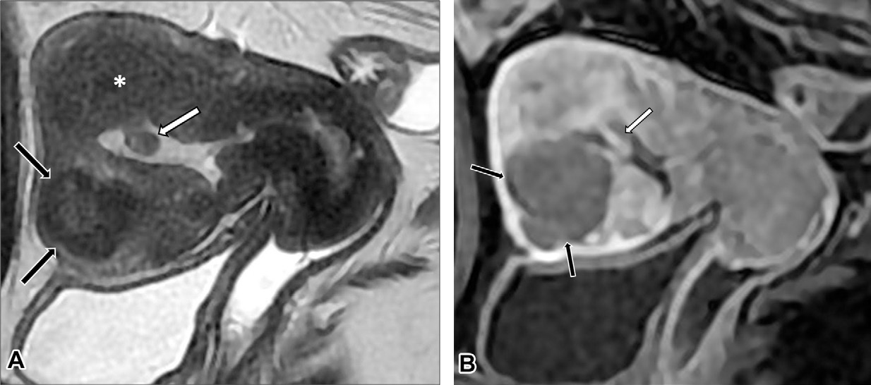 in a 33-year-old woman shows a hypointense intramyometrial mass in the left uterine wall with partially defined margins, minimal mass effect, and small internal hyperintense foci, which are findings characteristic of an adenomyoma (arrows).
- (B) Axial T2-weighted MR image during the third trimester of pregnancy when the patient was 36 years old shows a heterogeneously thickened left myometrium with scattered cystic areas (arrows). A normal placenta (black *) and an additional finding of a leiomyoma (white *) are also visible.