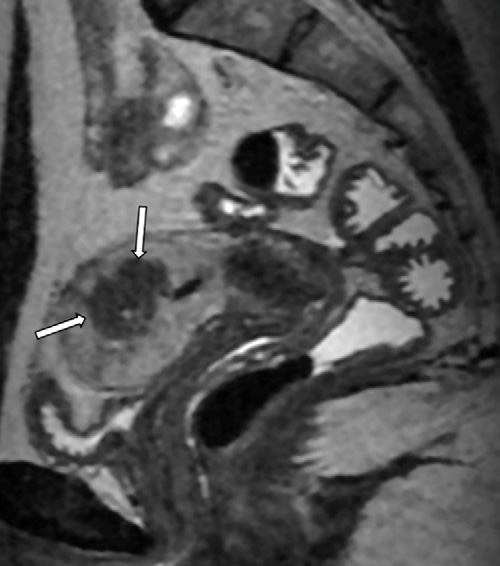 Figure 4. Adenomyoma in a 34-yearold woman with menorrhagia.
- Sagittal T2-weighted MR image shows a hypointense intramyometrial nodule in the posterior uterine wall, with partially defined margins, minimal mass effect, and small internal hyperintense foci (arrows).
