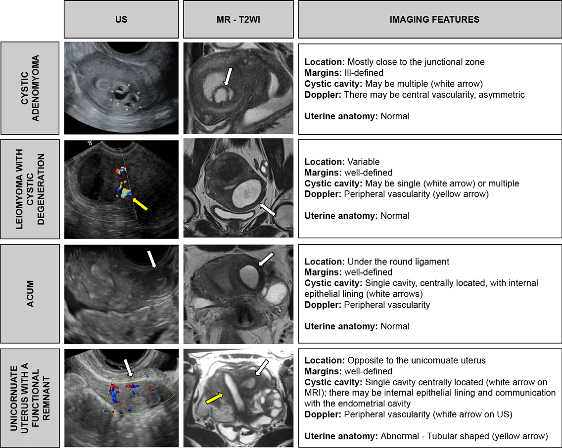 Figure 8. Tips for the differential diagnosis of cystic adenomyoma, leiomyoma with cystic degeneration, ACUM, and unicornuate uterus with a functional uterine remnant.
- T2WI = T2-weighted MRI.