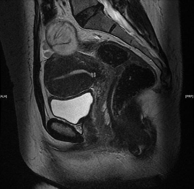 Adenomyosis 03