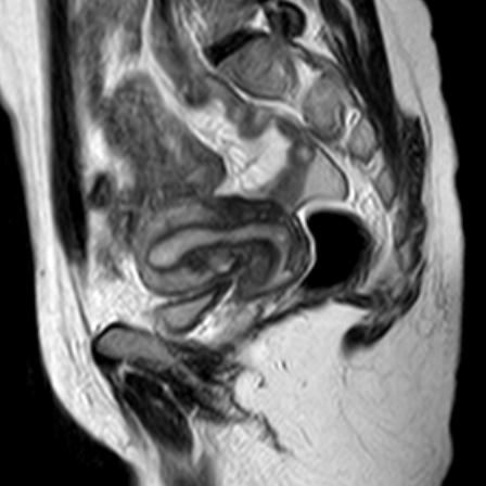 Transient physiological myometrial contraction