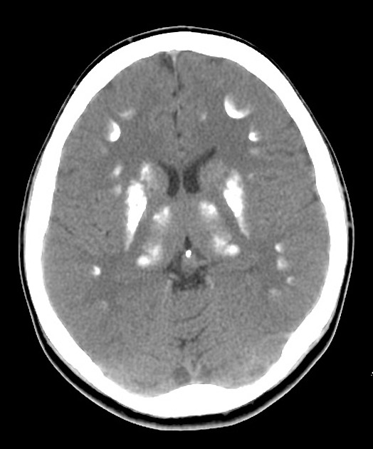 Pseudohypoparathyroidism