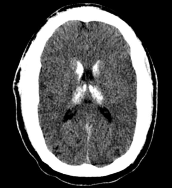 Farh disease