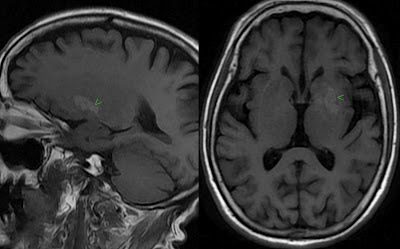 Hyperglycemic Hemichorea-Hemiballismus