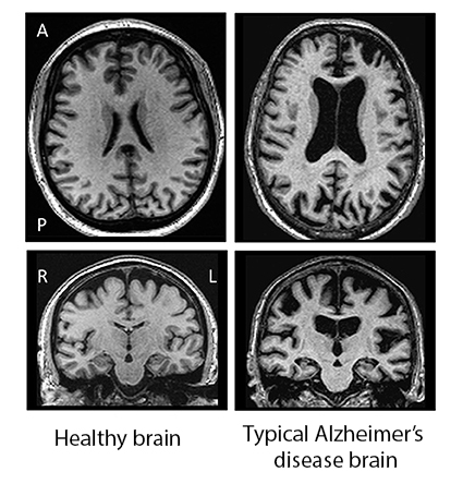 Healthy and Alzheimer disease MRI