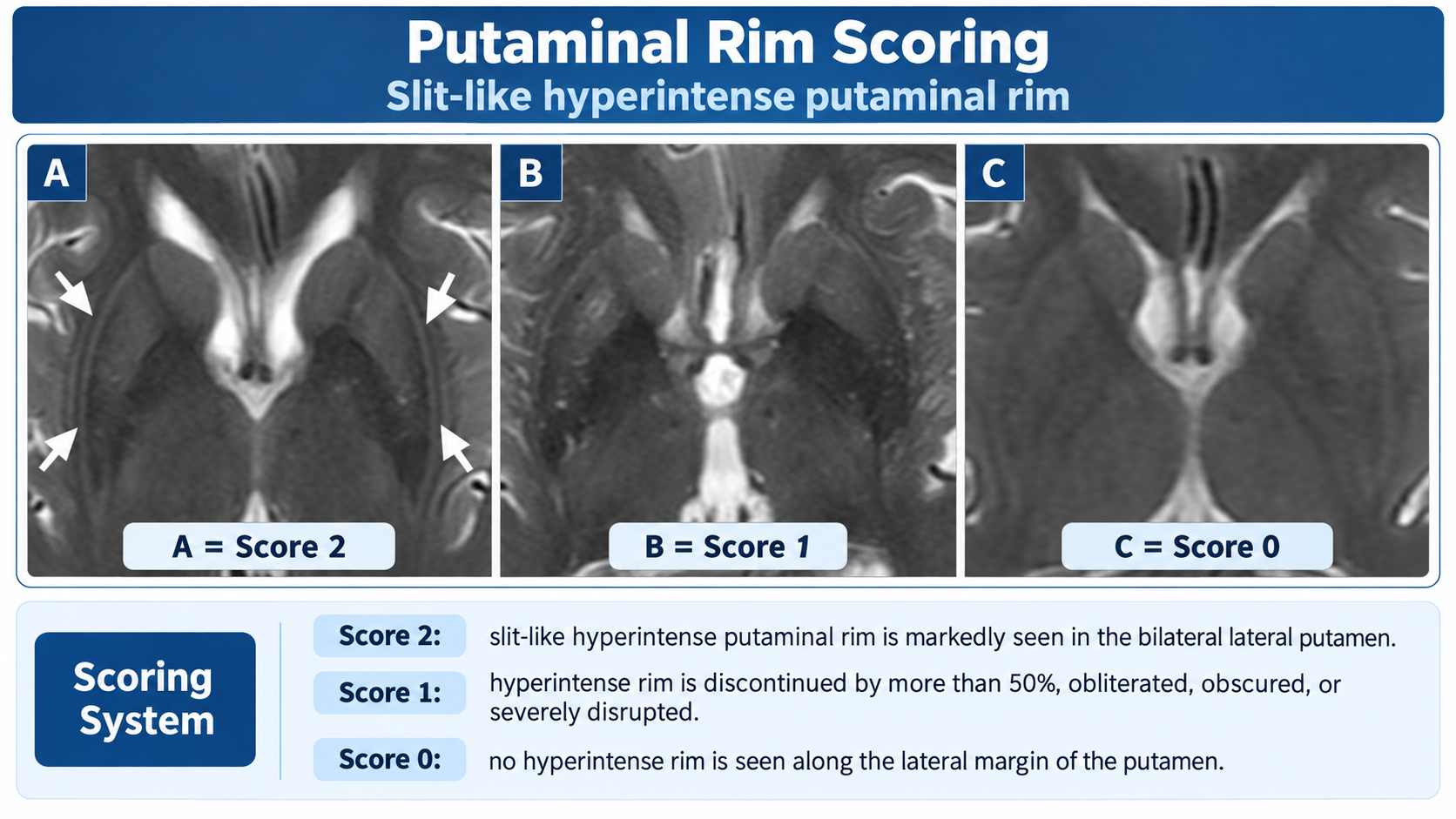 Putman Rim Sign Score