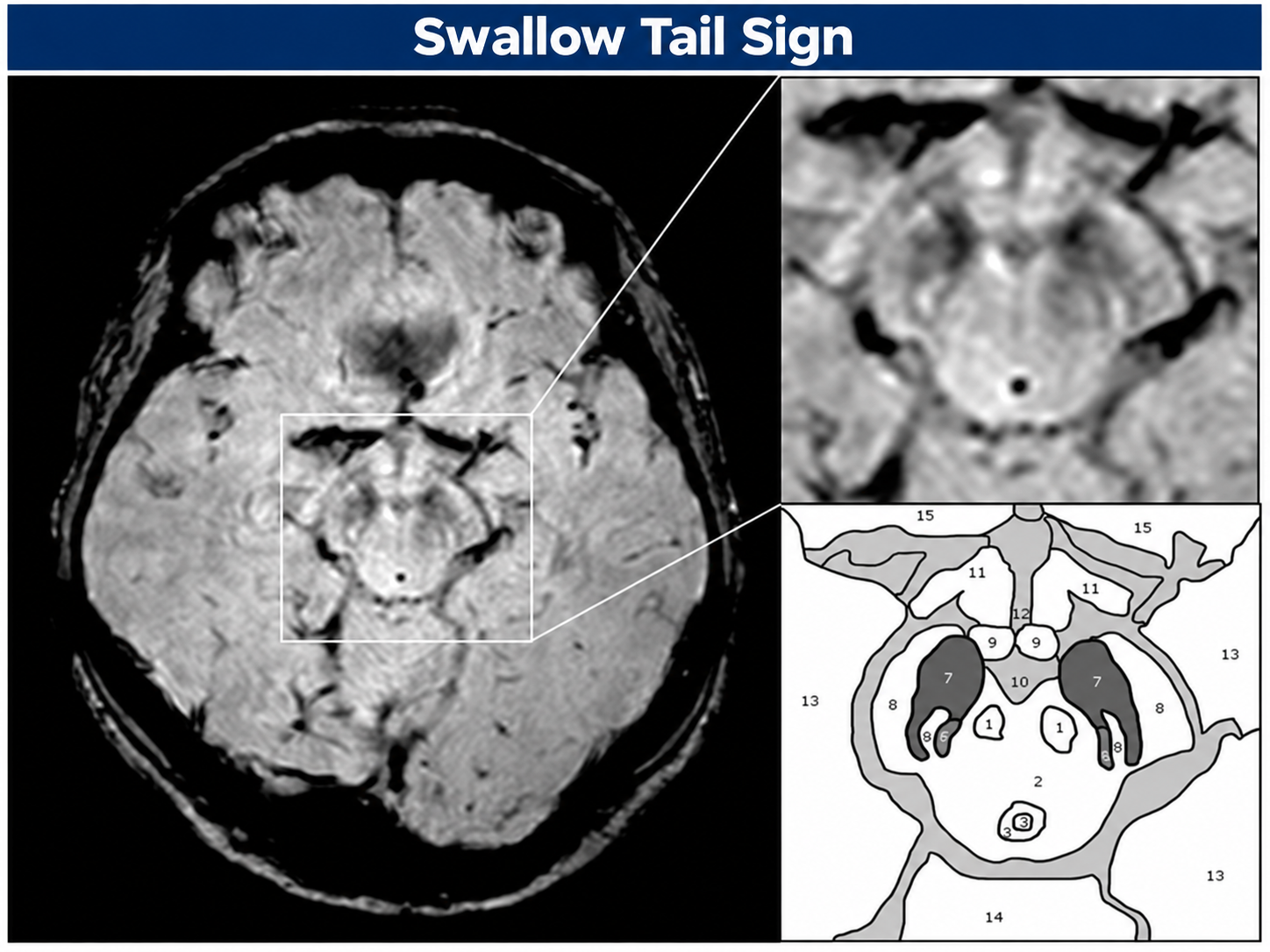 Swallow tail sign MRI with anatomical diagram