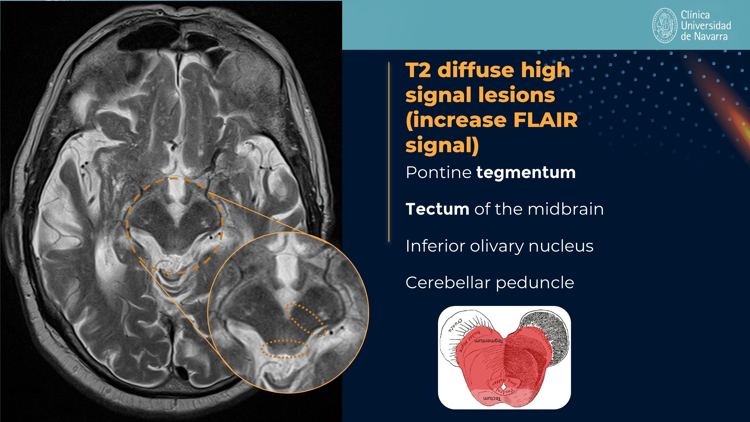 Axial MRI illustration listing T2 and FLAIR signal findings in PSP