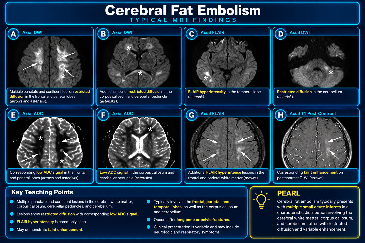 Cerebral Fat Embolism