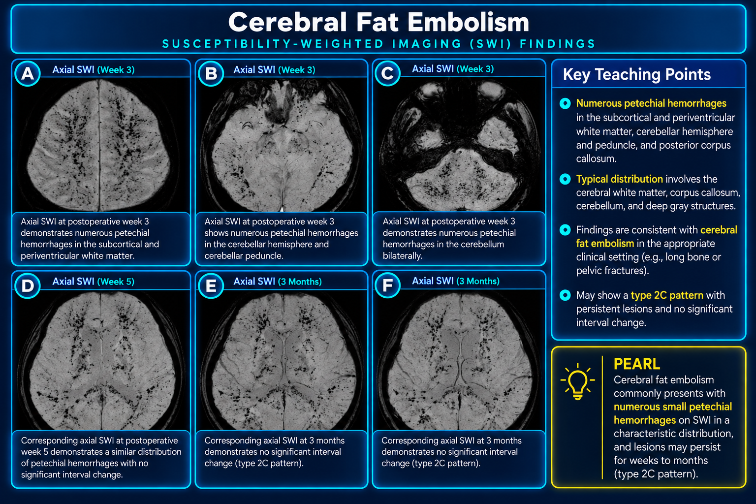 Cerebral Fat Embolism - SWI