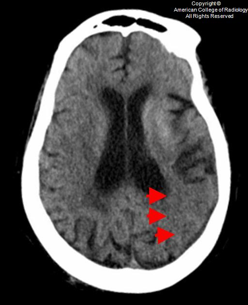 A non-contrast head CT 11 days post-infarction



Demonstrates subtle sulcal effacement and loss of gray-white differentiation (red arrows) involving the left temporoparietal region, representative of fogging effect of a subacute left MCA M2-territory infarction.