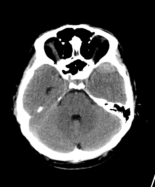 Anterior middle cranial fossa extradural hemorrhages are thought to arise from the sphenoparietal sinus which runs along the superior margin of the greater wing of sphenoid.
Due to their location, the anatomy of dural attachments and venous origin, they do not cause midline shift or herniation, rarely grow, and can generally be managed conservatively