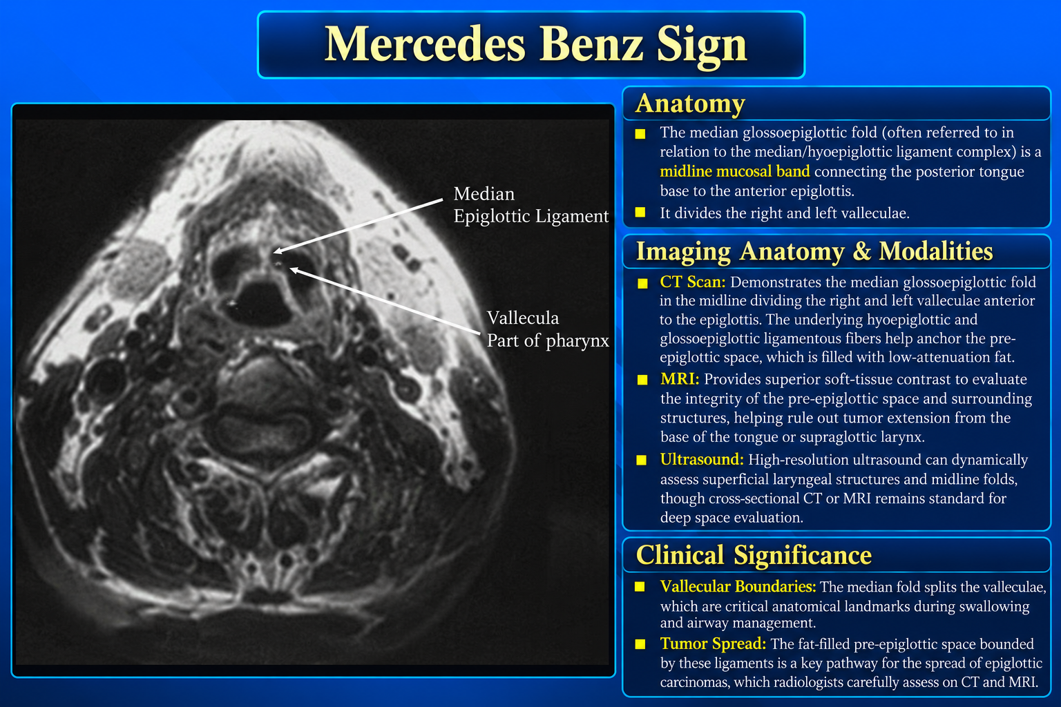 Median glossoepiglottic fold and vallecular anatomy