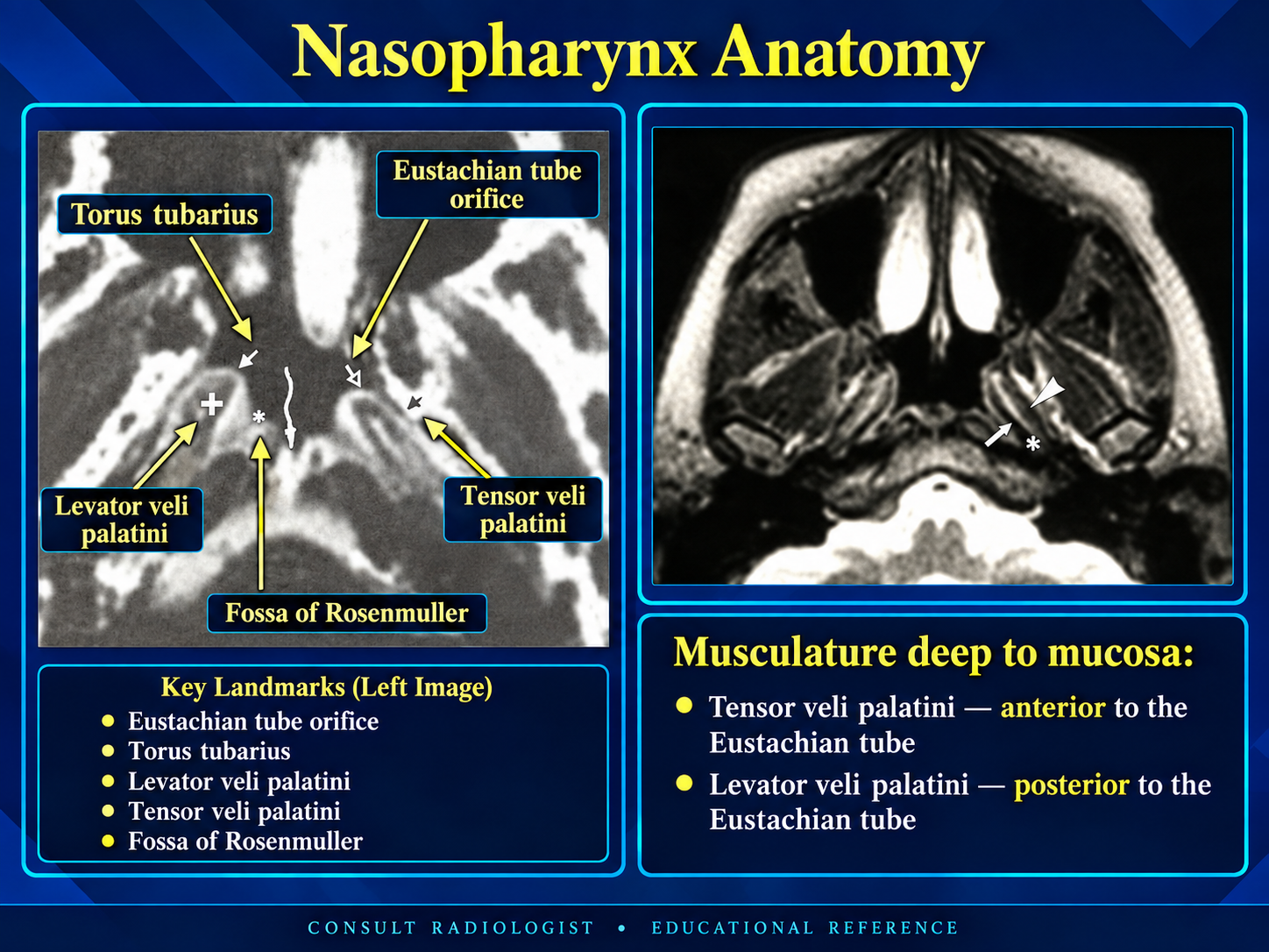 Nasopharyngeal lateral wall and Eustachian tube landmarks
