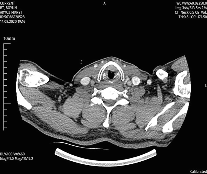 Axial contrast CT example of a subglottic lesion
