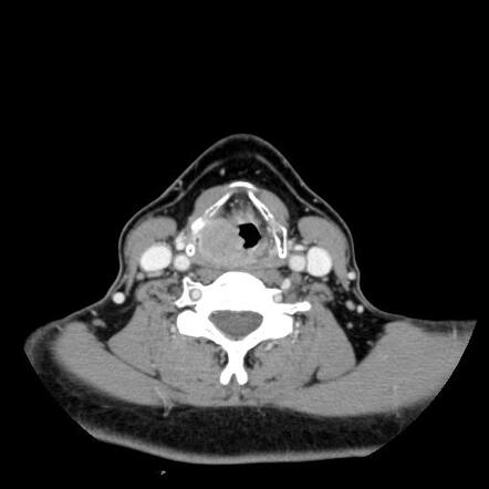 Axial contrast CT example of a supraglottic mass