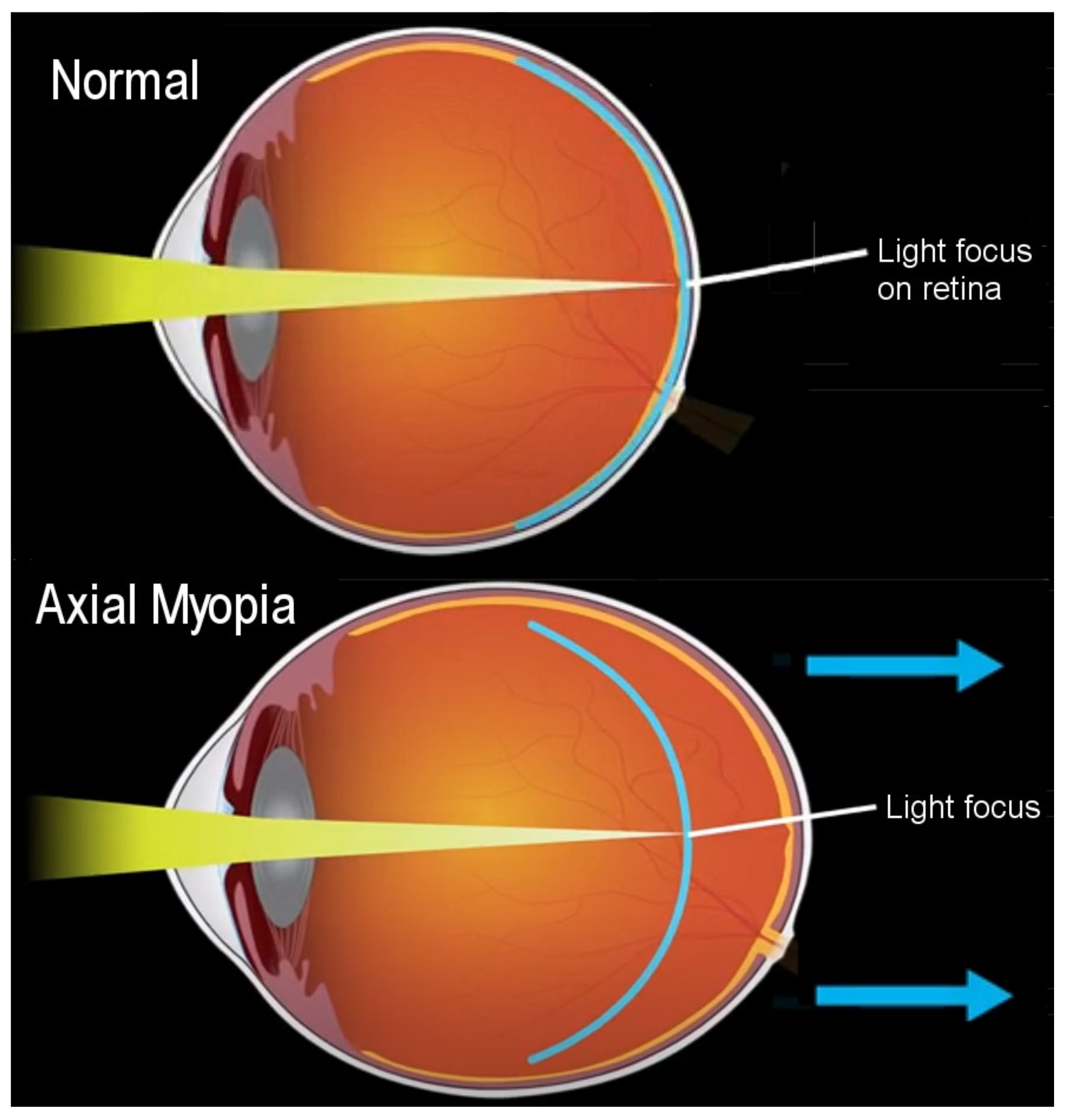 Axial Myopia