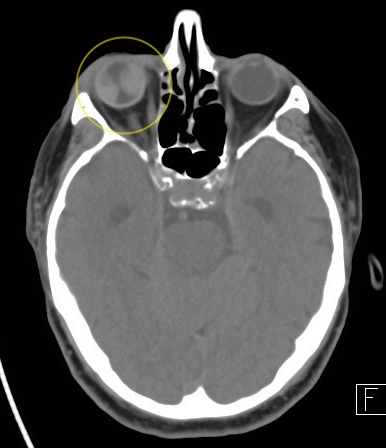 Hemorrhagic Choroidal detachment