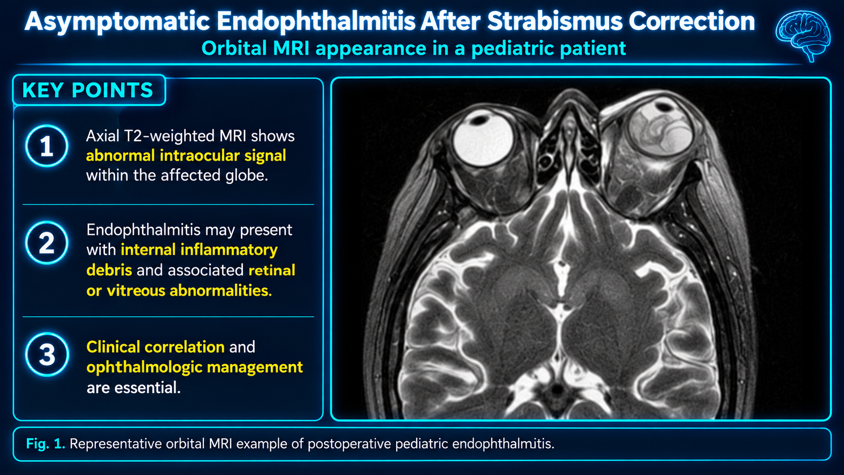 Asymptomatic endophthalmitis after strabismus correction