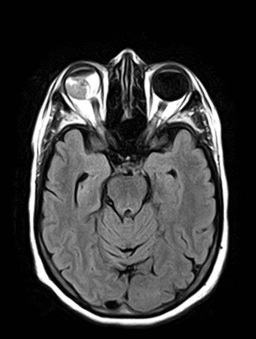 Posterior vitreous hemorrhage