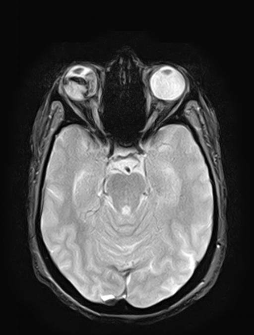 Posterior vitreous hemorrhage