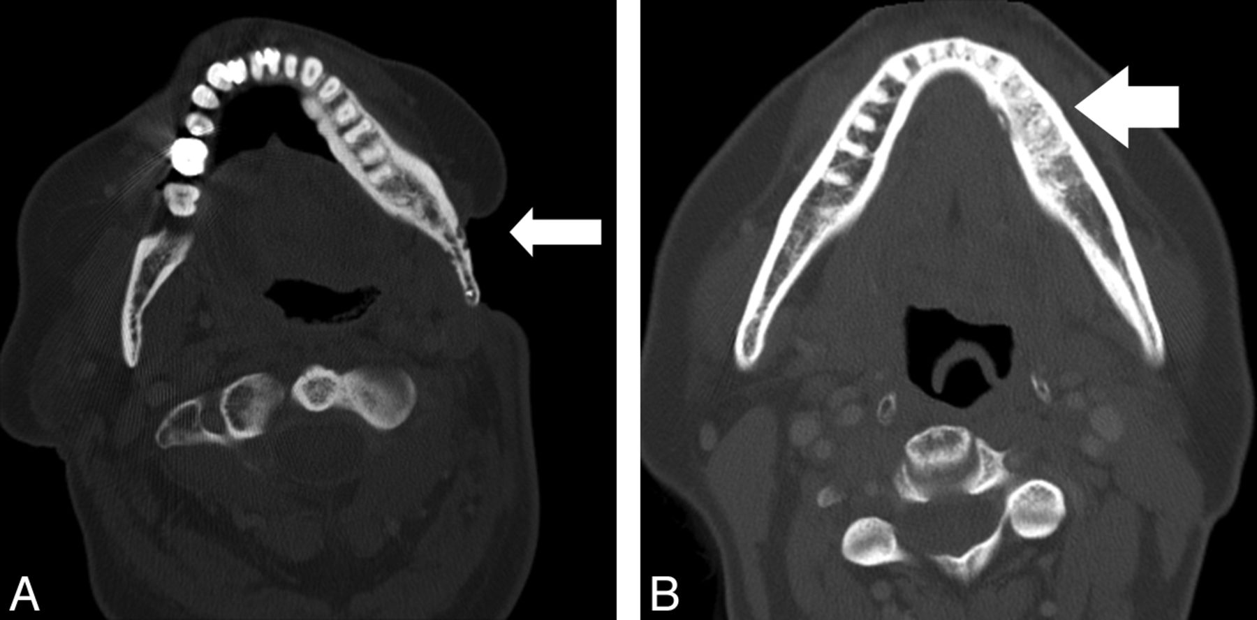 A, Axial CT scan (bone algorithm) shows ORN involving the mandibular angle with an adjacent soft-tissue defect. Areas of permeative trabecular loss (white arrow) are evident. B, Axial CT scan (bone algorithm) shows ORN involving the left mandibular body with bony sclerotic changes (white arrow) evident.