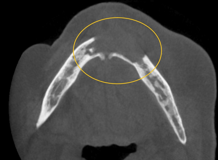 Bony sequestra in the mandible along with discontinuity in the buccal cortical plate (yellow circle).