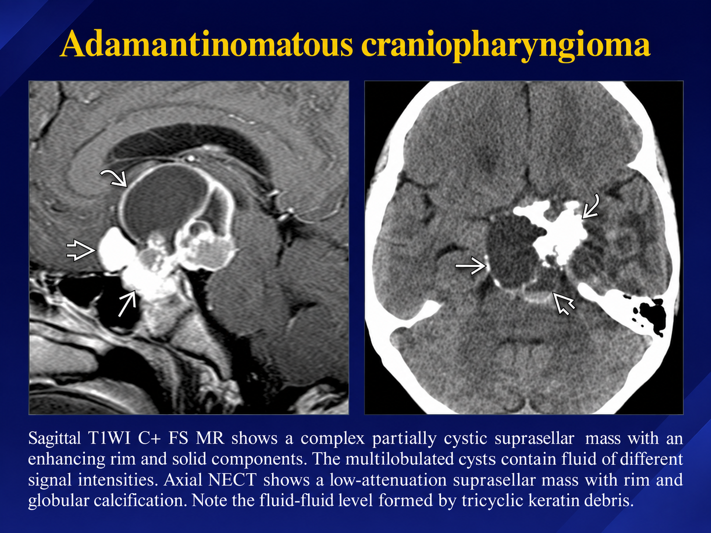 MRI and CT appearance of adamantinomatous craniopharyngioma with cystic components and calcification