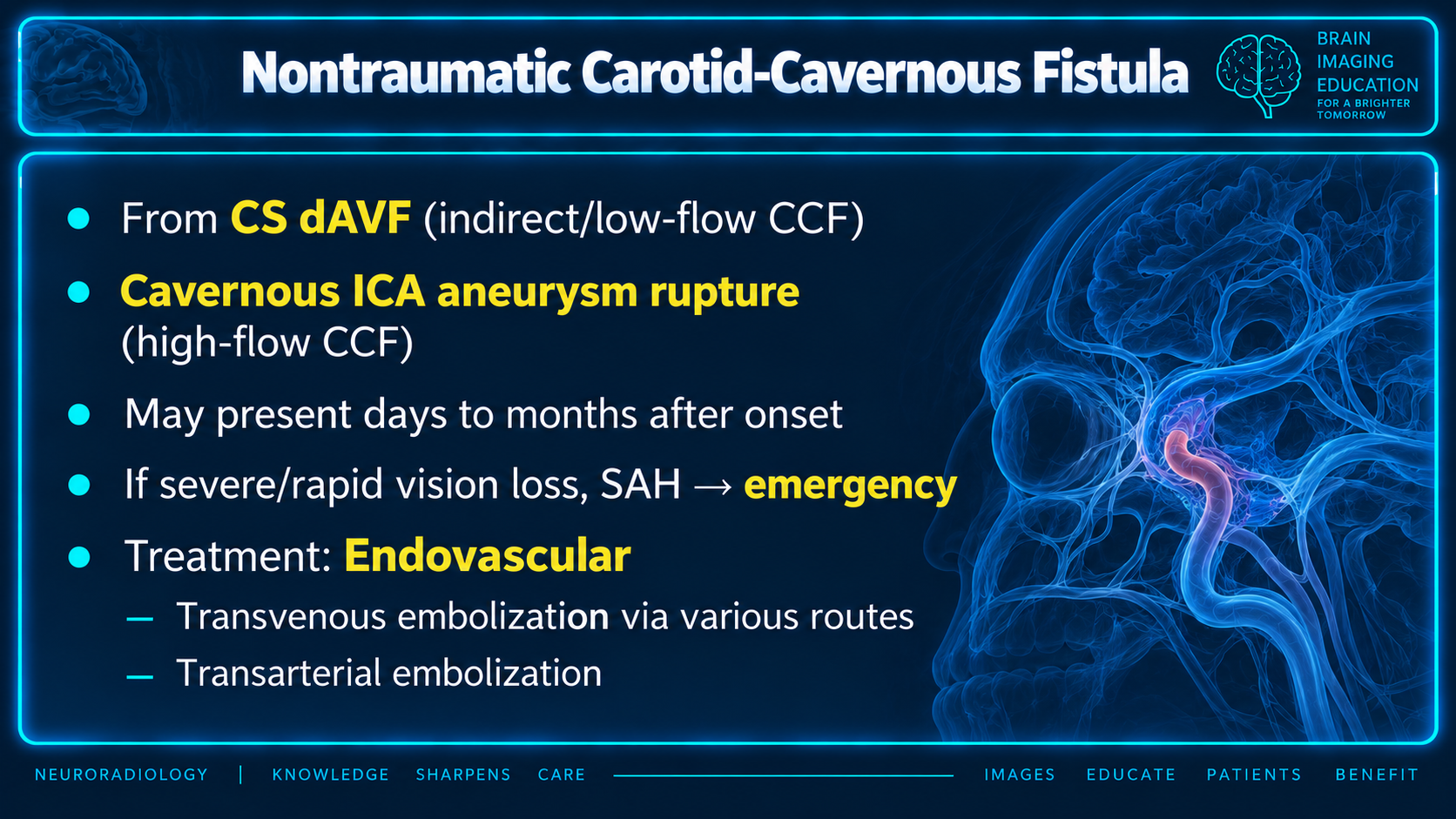 Nontraumatic carotid cavernous fistula teaching points