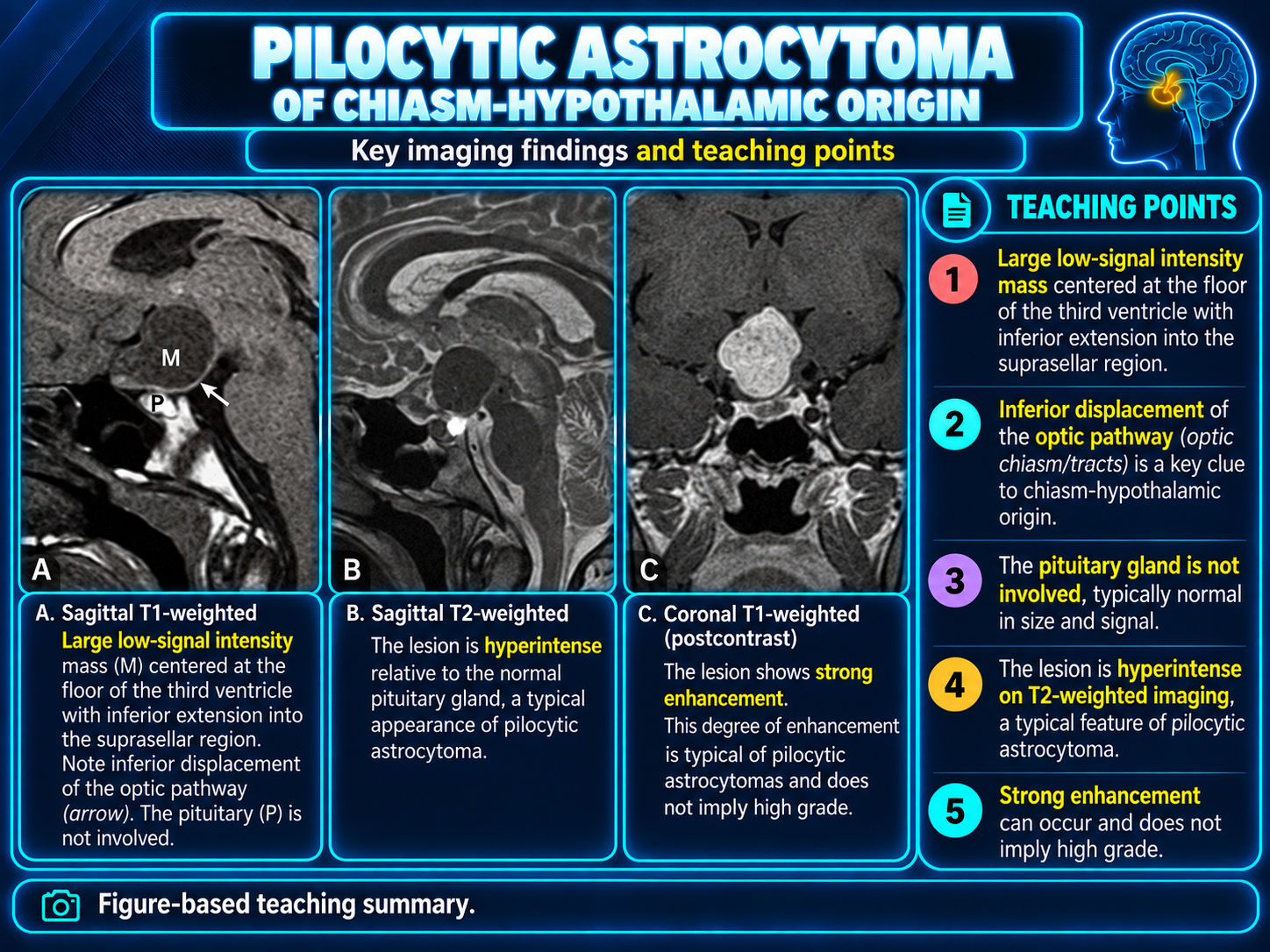 Pilocytic astrocytoma of chiasmatic hypothalamic origin