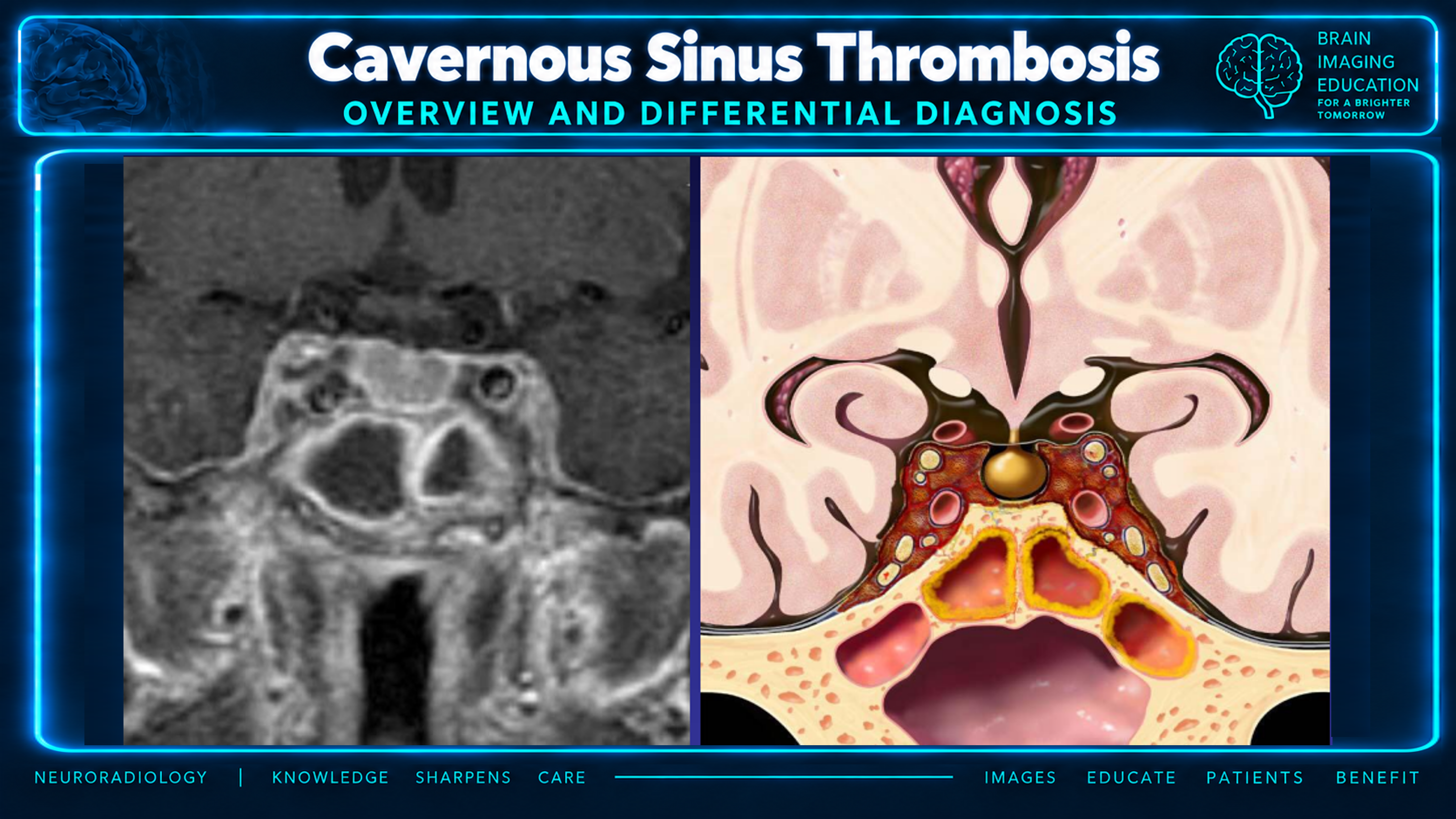 Coronal MRI and graphic of cavernous sinus thrombosis