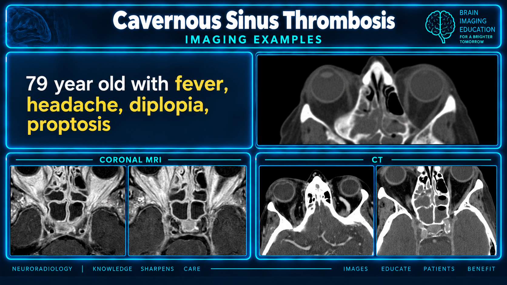 CT and MRI imaging example of septic cavernous sinus thrombosis