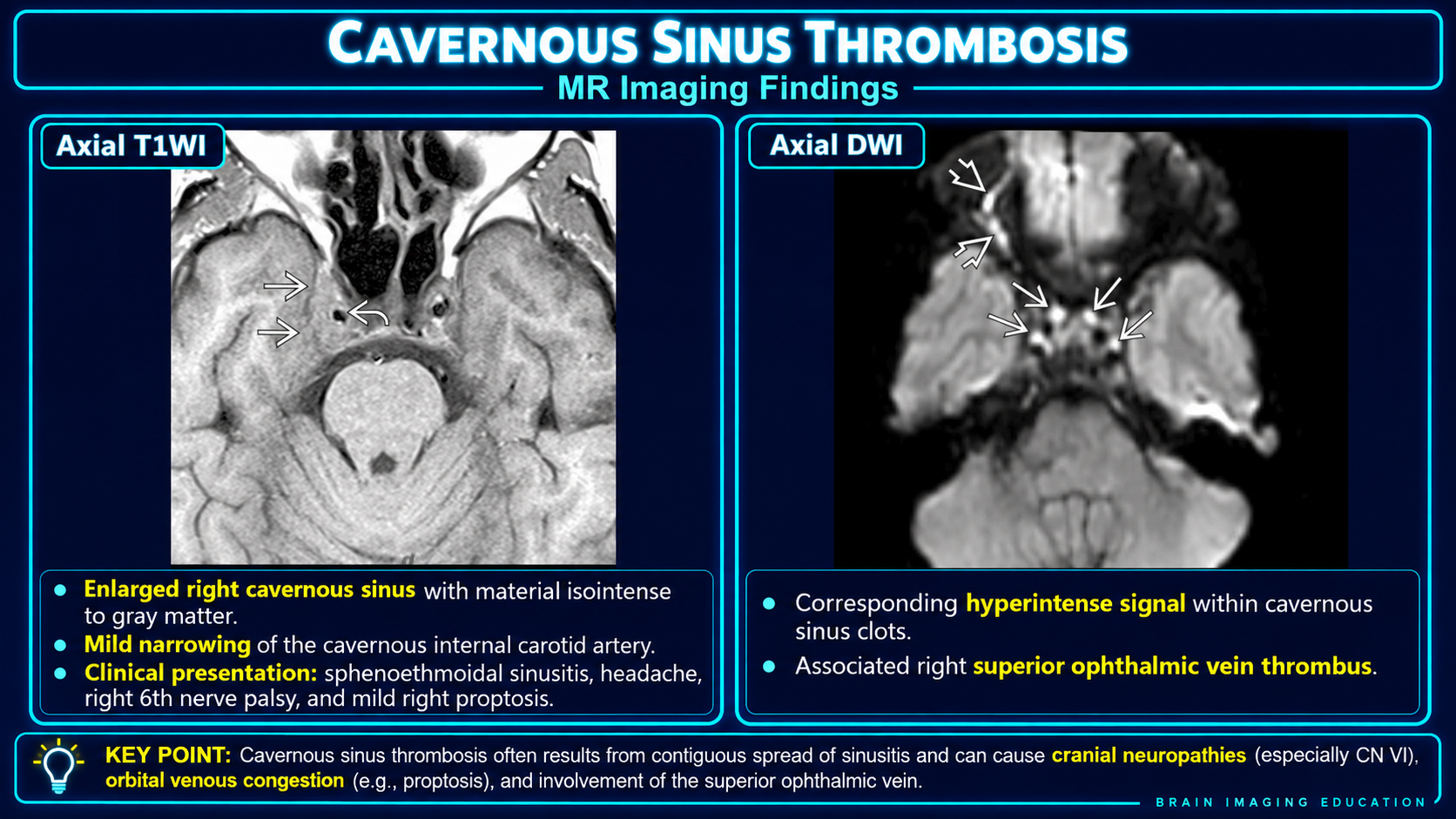 T1 and diffusion MRI findings of cavernous sinus thrombosis