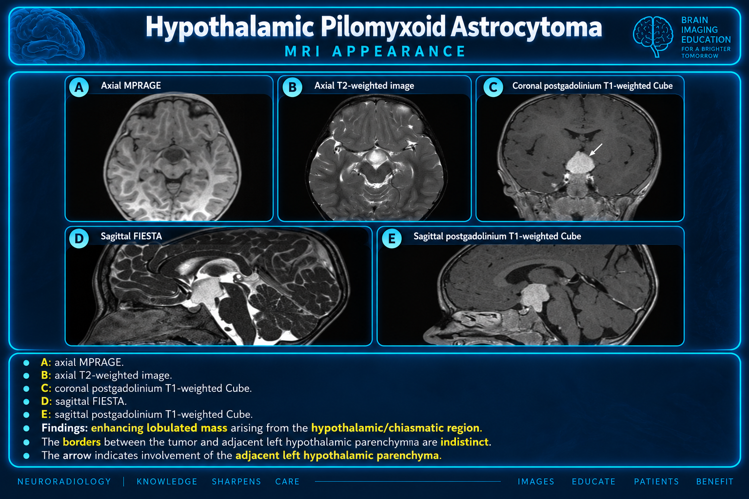 Hypothalamic pilomyxoid astrocytoma MRI appearance