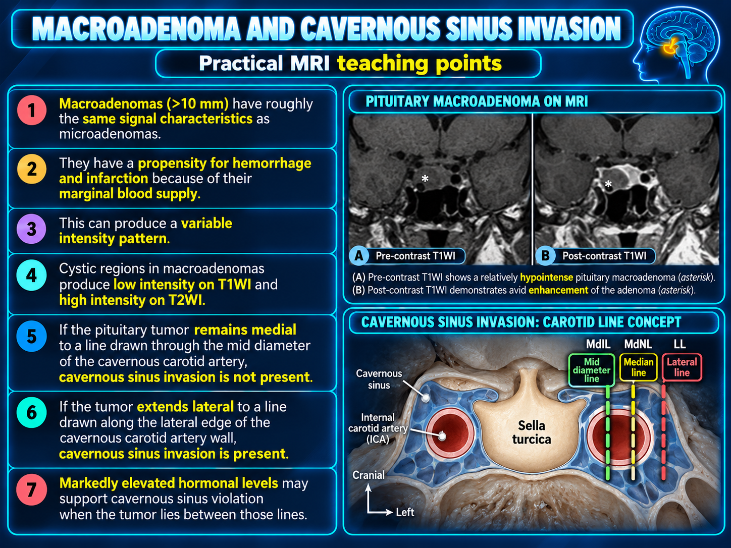 MRI teaching points for pituitary macroadenoma and cavernous sinus invasion