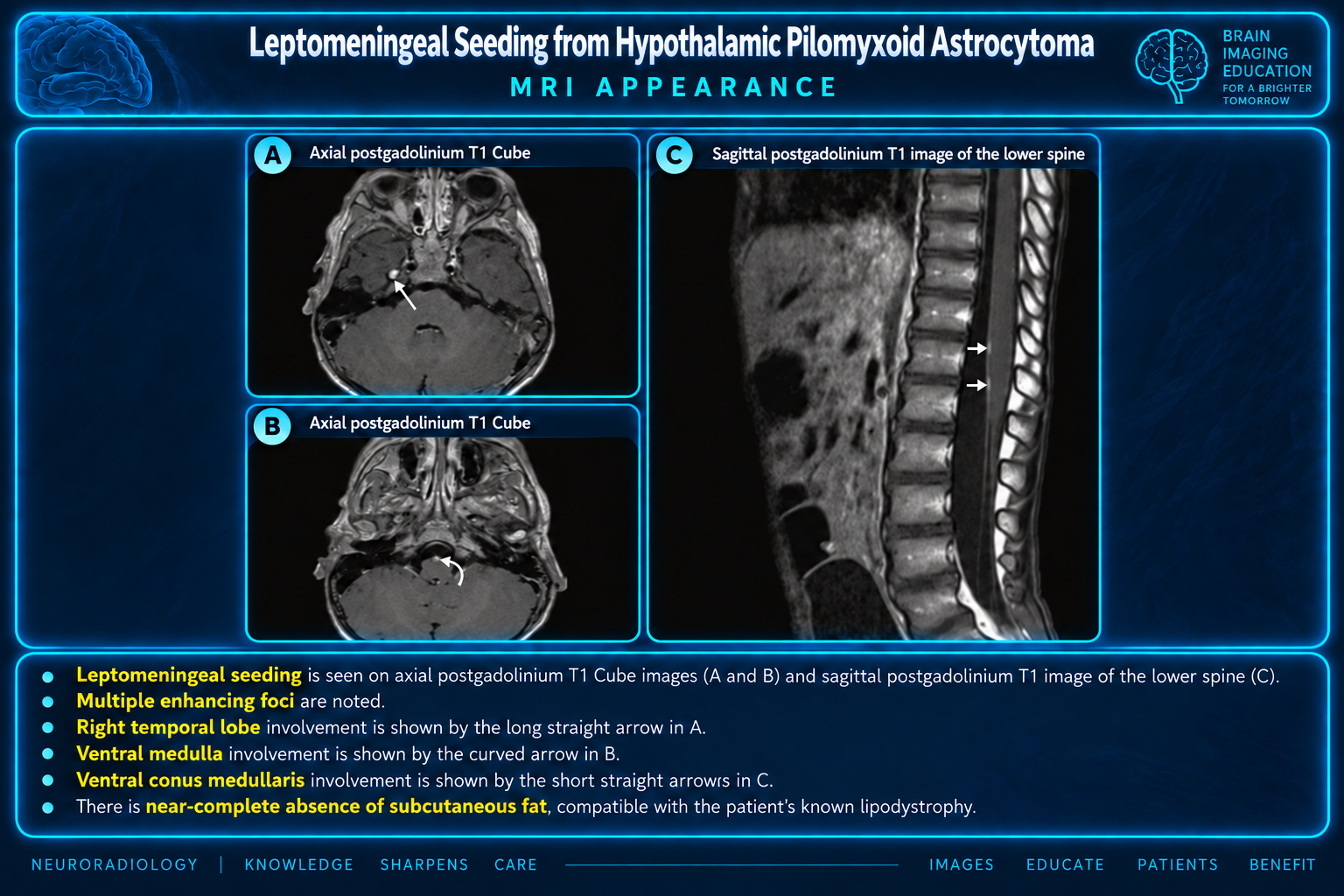 Leptomeningeal dissemination from hypothalamic pilomyxoid astrocytoma