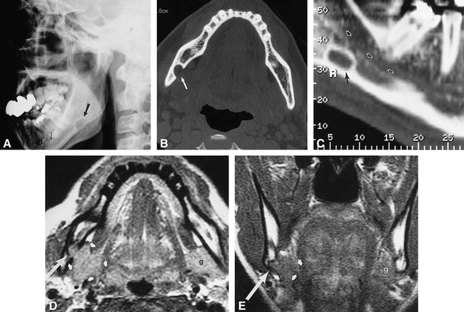 A, Lateral radiograph shows a radiolucent, ovoid, corticate lesion anterior to the right mandibular angle (arrow).
B, Dental CT scan, axial view, shows the radiolucency (arrow) to be a corticate defect on the lingual surface of the mandible.
C, On parasagittal curved reformatted image, the defect (black arrow) is seen to lie below the lower margin of the inferior alveolar canal (white arrows).
D, Axial proton density--weighted MR image (3300/17/1) shows that the mandibular defect (long arrow) contains soft tissue in continuity with, and isointense with, the submandibular salivary gland (short arrows). The contralateral gland (g) is marked for comparison.
E, Coronal T1-weighted MR image (600/16/1) again shows that the bony defect (long arrow) contains an extension of tissue from the submandibular gland (short arrows).