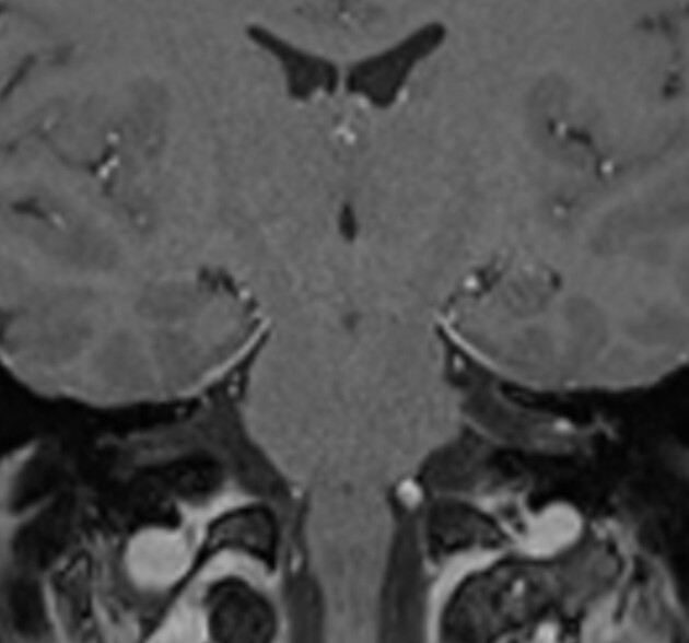 Lyme Disease (Left)