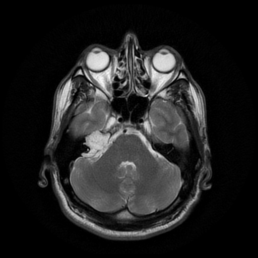 Petrous apex cholesteatoma