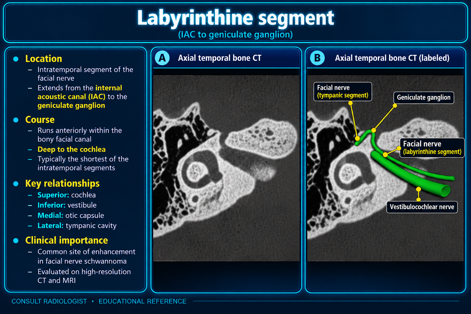 Axial temporal bone CT of the labyrinthine facial nerve segment