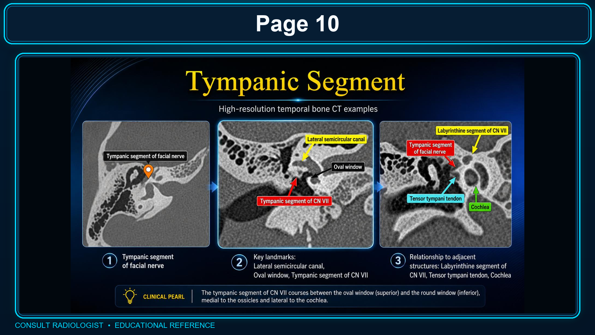 High-resolution CT examples of the tympanic facial nerve segment