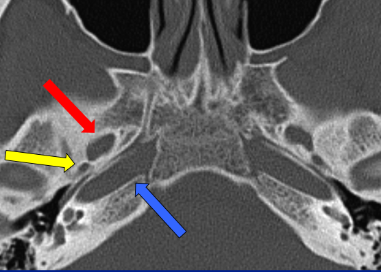 Foramen Spinosum (Yellow arrow)

Transmits the middle meningeal artery, middle meningeal vein, and (usually) the nervus spinosus.



Foramen Ovale (Blue Arrow)