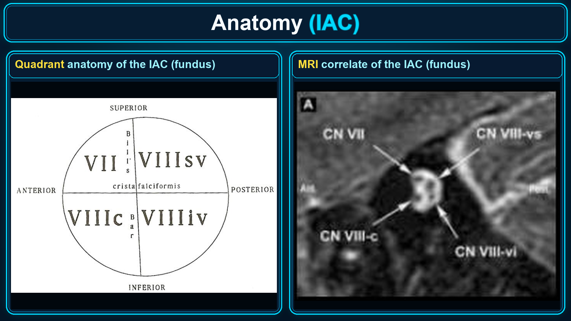 Internal auditory canal fundus quadrant anatomy and MRI correlate